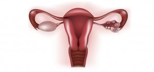 sindromul ovarelor polichistice - doctor dan raica